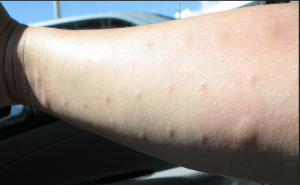 allergic rash on hand