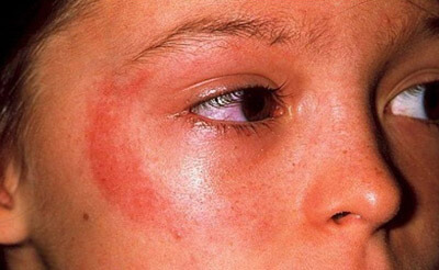 What is the treatment for sun allergy?