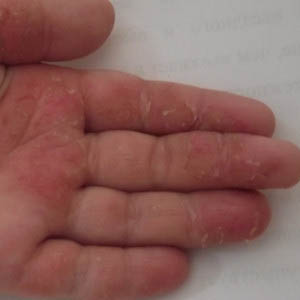 dermatitis on the hands