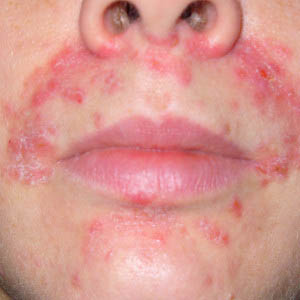 dermatitis on the face
