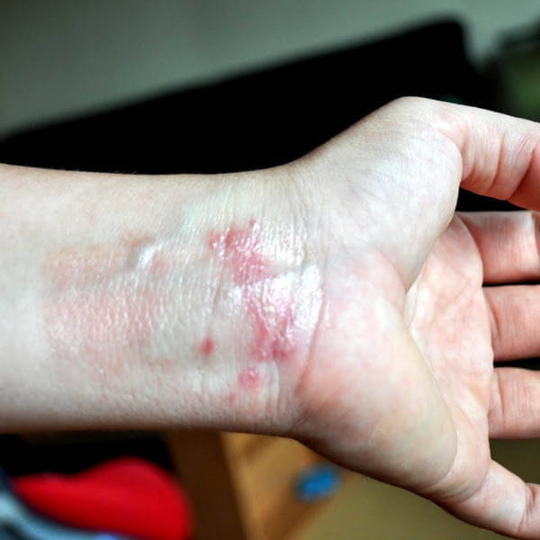 dermatitis on the hands 