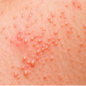 dermatitis on the skin 