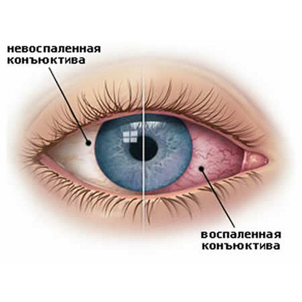 Герпесный конъюнктивит