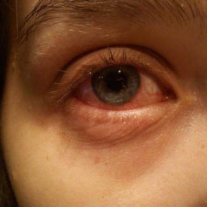 allergies and conjunctivitis