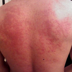 hives on the back