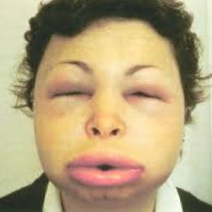 angioedema on the face