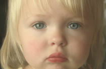 Как распознать аллергию у ребенка